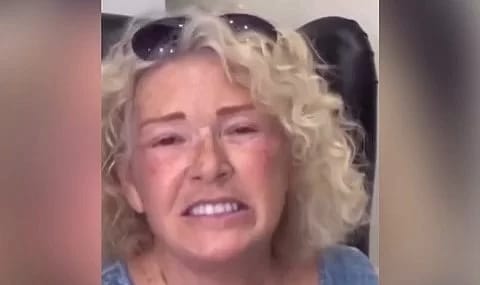 Yaşlı kadının estetik sonrası değişimi gündem oldu