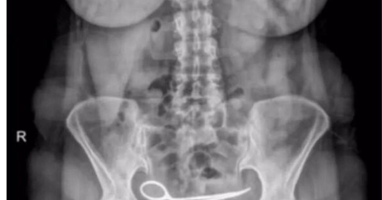 Gerçeği öğrenince dünyası başına yıkıldı! Hiç haberi olmadan 8 ay karnında yaşamış