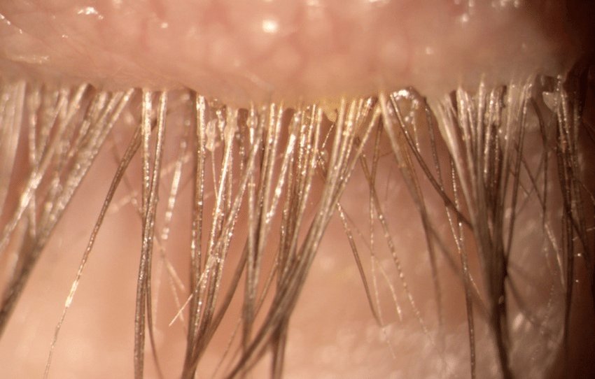 Bu Parazitler Cildimizde Yaşıyor! Zararları Nedir?