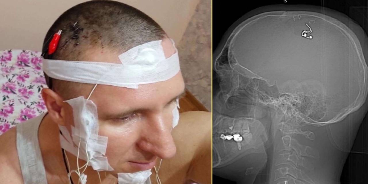 Rüyalarını Kontrol Edebilmek İçin Kafasını Matkapla Delip, Çip Taktı