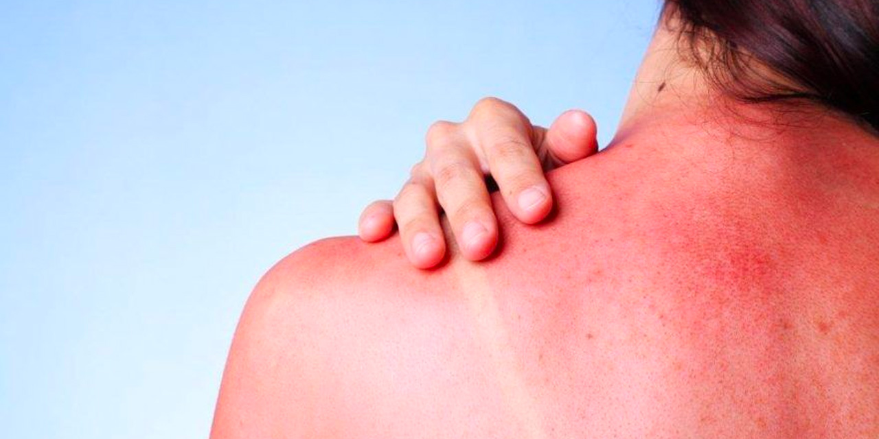 Doğru bilinen büyük yanlış! Güneş yanığına asla yoğurt sürmeyin! İşte iyi gelen şeyler...