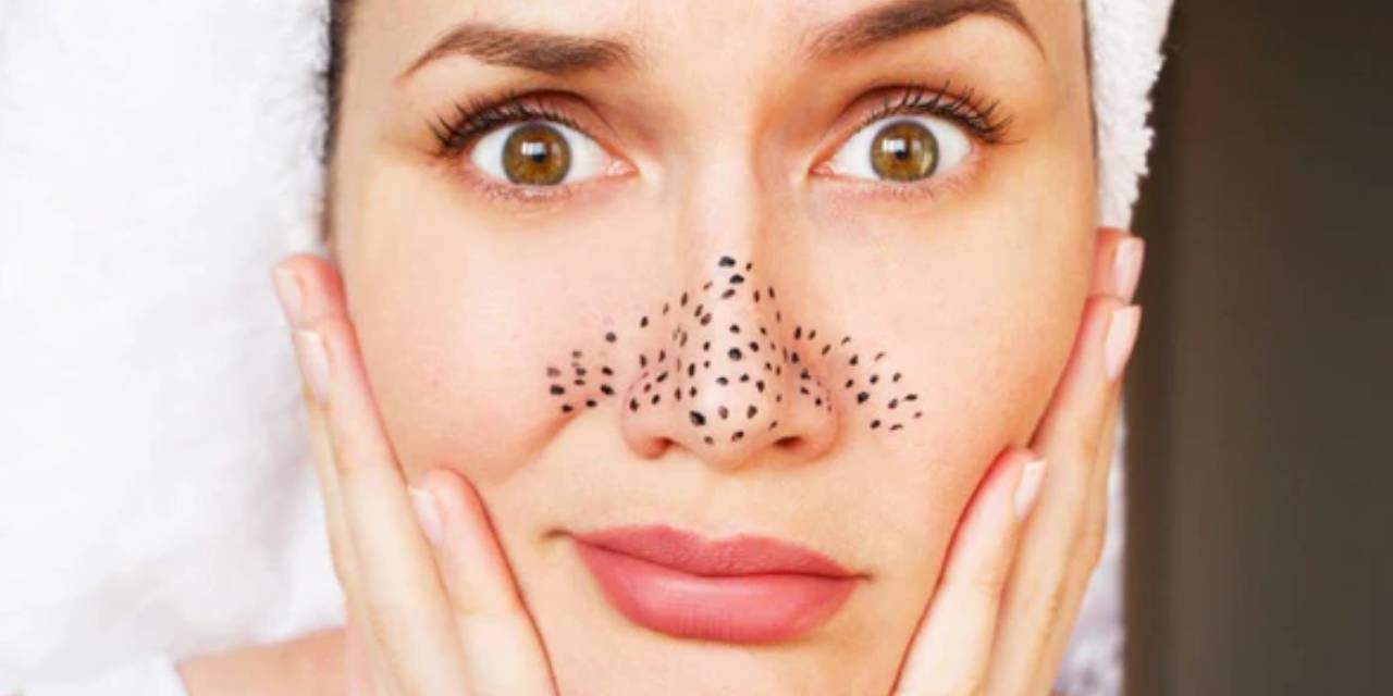 Siyah noktalar için yeni trend: Fiddy metodu nedir?