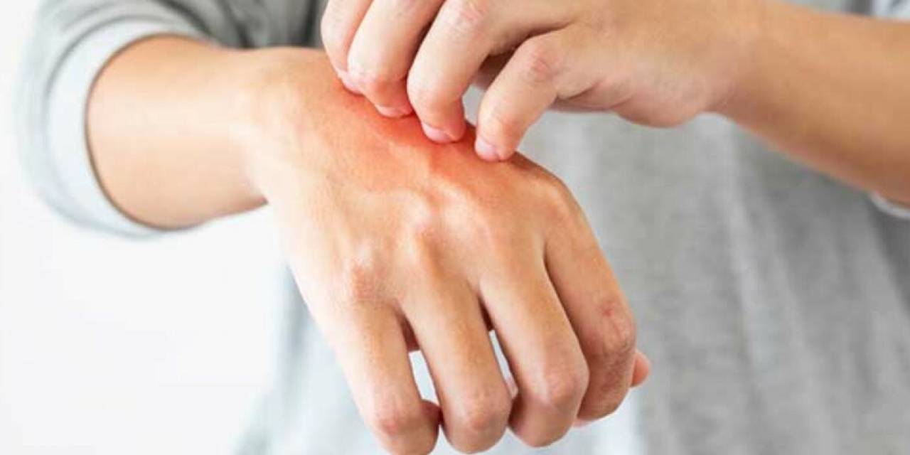 Bu da Alfa-gal sendromu... Yüzbinlerce kişiyi etkilemiş olabilir! Peki Alfa-gal sendromu nedir?