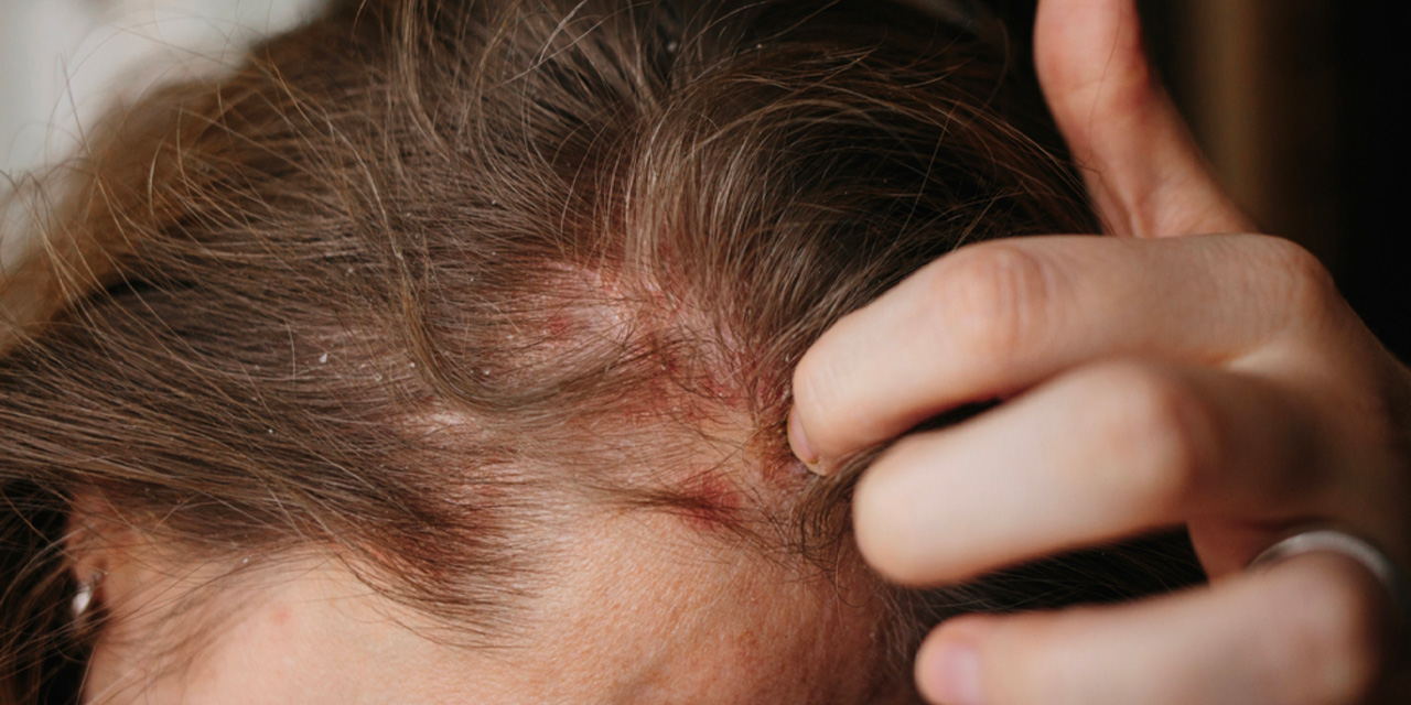 Saç diplerindeki egzama, kaşıntı ve iltihaplanmayı kökten çözüyor! Şampuanın içine 1 damla ekleyin