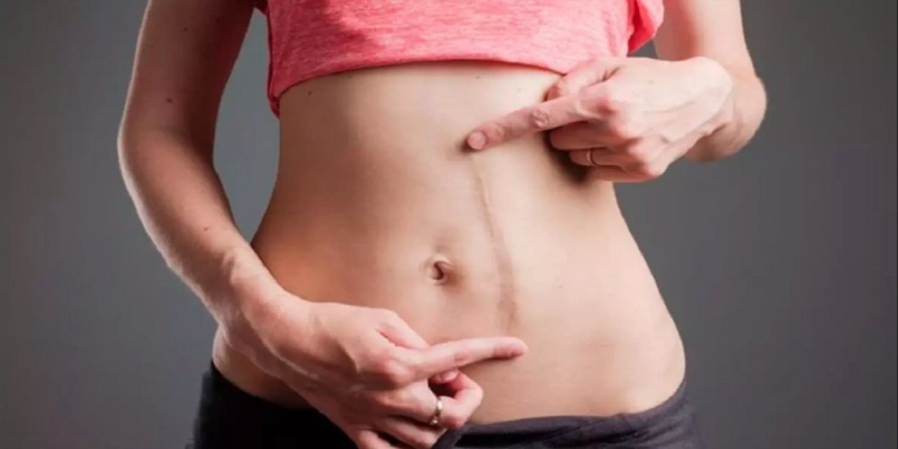 Kadınlara müjde: Ameliyat izleri tarihe karışıyor! Artık izleri kapatmanıza gerek kalmayacak