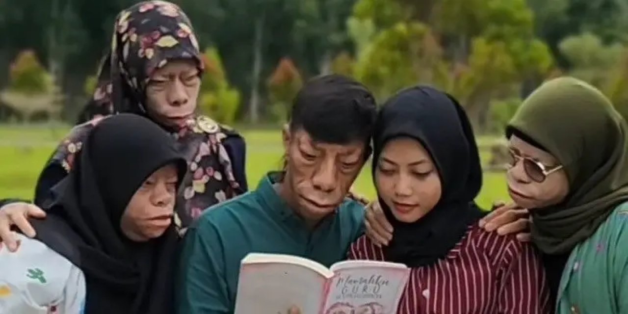 Bir Aileyi Tümden Etkileyen Nadir Bir Hastalık! Kertenkele İnsanlar Genetik Bir Hastalıktan Muzdarip