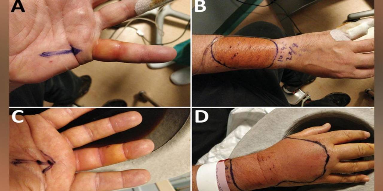 Sokak kedisi ısırdı, daha önce hiç bilinmeyen bir enfeksiyon kaptı! Isırıldıktan 8 saat sonra...