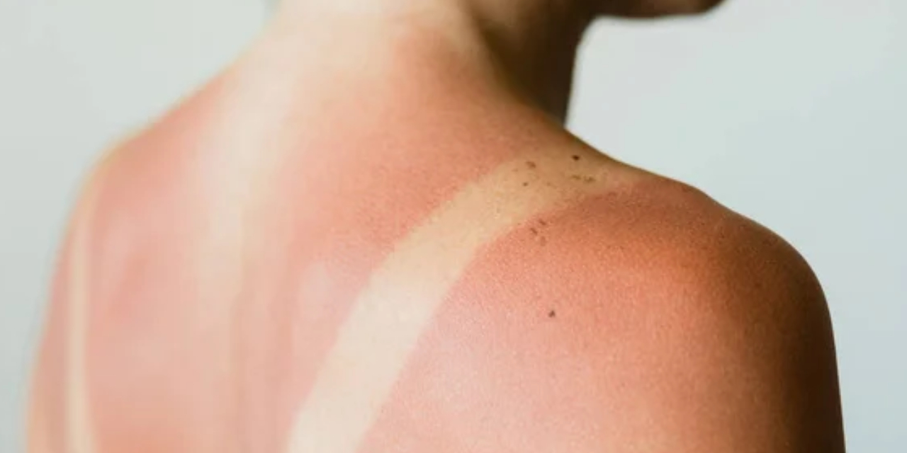 Evde yapacağınız güneş yanığı tedavisi...Gerçekten işe yarıyor....