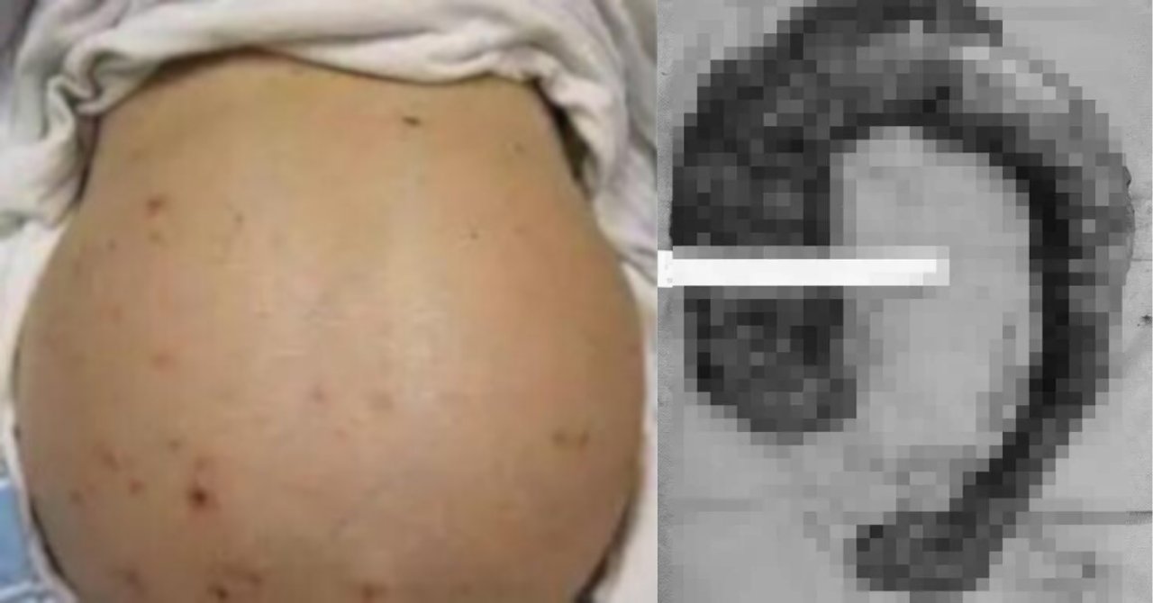 Görenler hamile sandı gerçek başka çıktı! 10 gün boyunca tuvaletini yapmadı olanlar oldu!