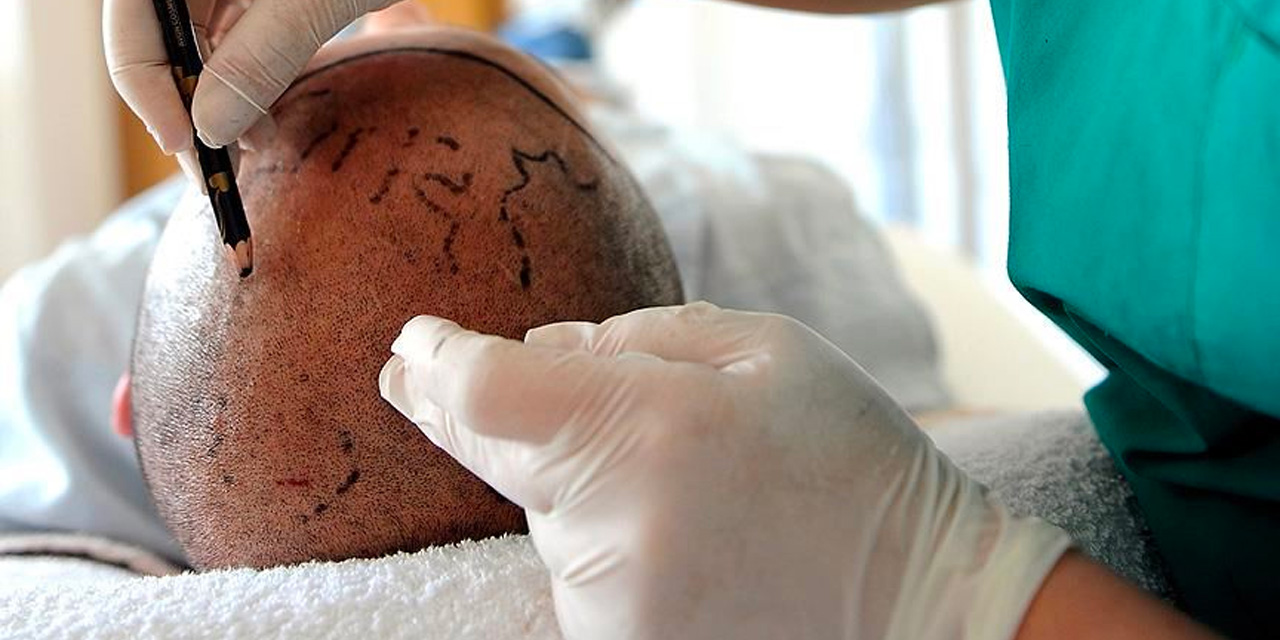 Herkes saç ektirebilir mi? Uzmanlar açıkladı...