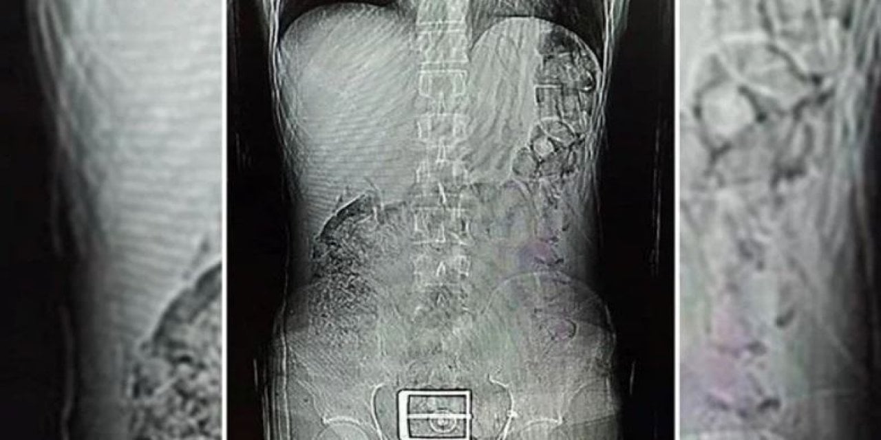 Röntgende Ortaya Çıktı! Mide Ve Bağırsağından Çıkanlar Şok Etti!