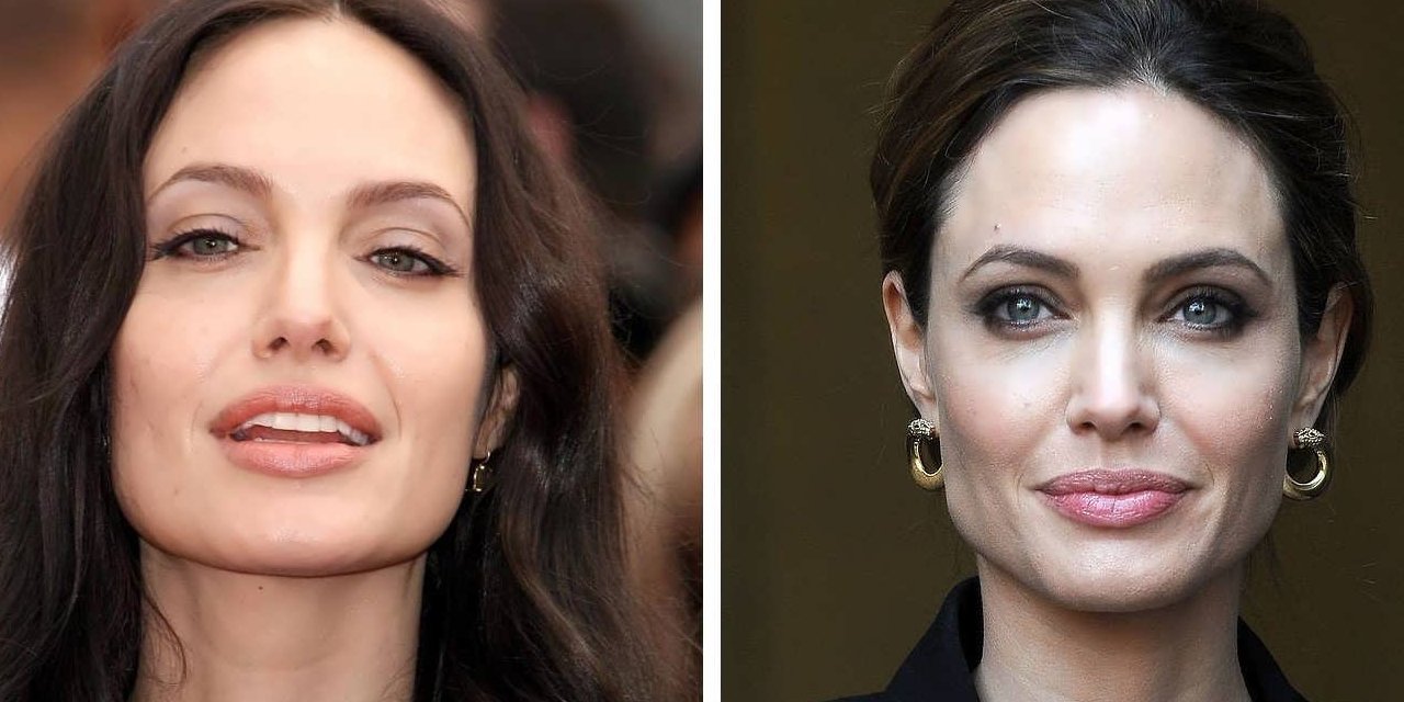 Genetik Mutasyonda Angelina Jolie Yöntemi