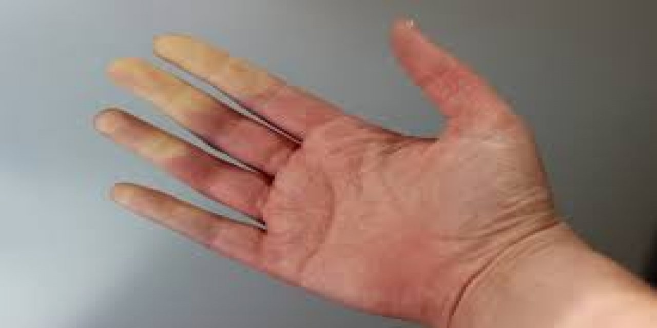 Elleriniz Neden Her Zaman Soğuk ? Raynauds Olarak Bilinen Şok Edici Hastalık