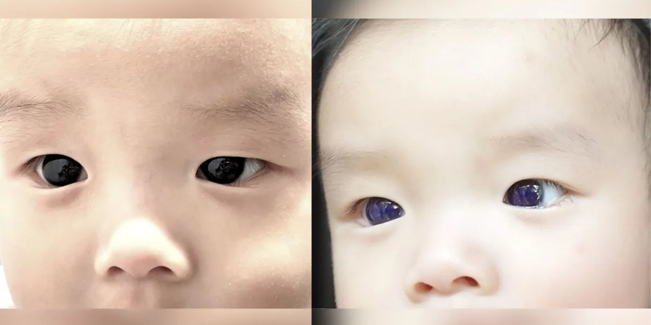 Bebeğin koyu kahverengi gözleri, COVID- antiviral tedavisinden sonra aniden çivit mavisine döndü: Ama neden?