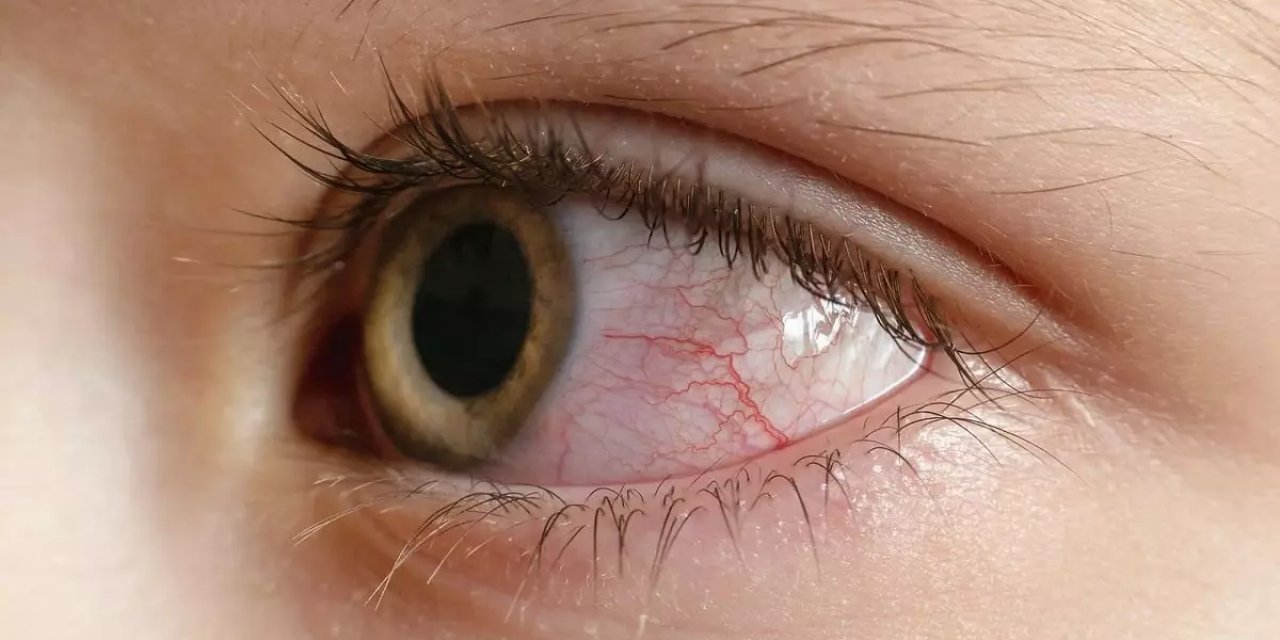 Dikkat! Kırmızı Göz Alarmı : Gözünüzü Kaybetmek İstemiyorsanız Kırmızı Göz Hastalığını Ciddiye Alın...