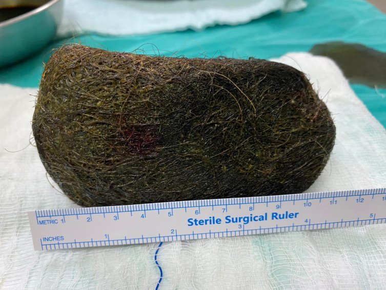 Midesinden 2 Kilo Saç Çıktı