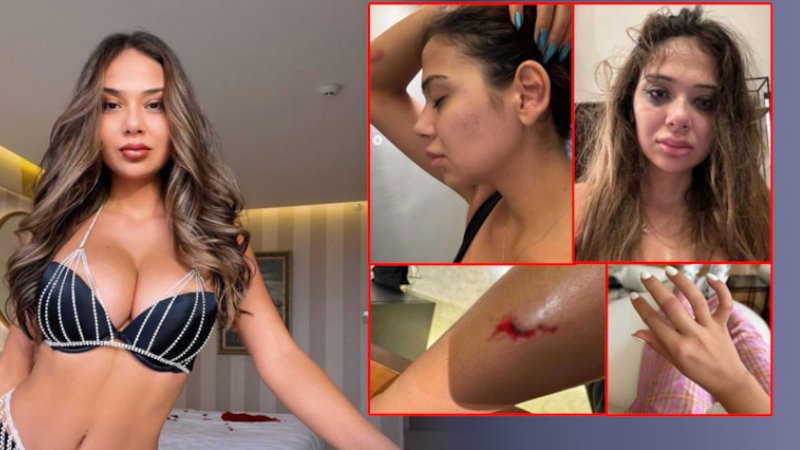 Onlyfans Modeli Merve Taşkın Sevgilisinden Şiddet Gördü!: Burnumu yumrukladı, cinsel organıma tekme attı