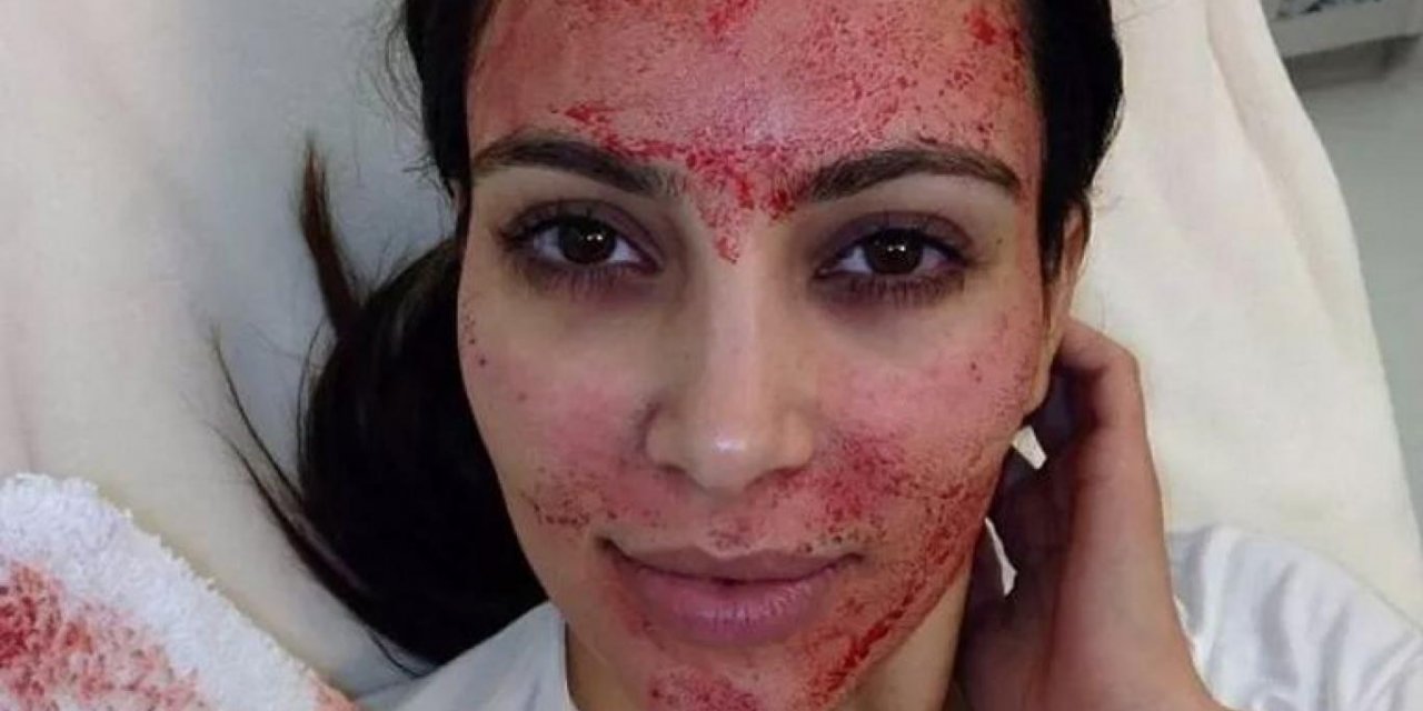 Kim Kardashian'ın Vampir Bakımından AIDS Bulaştı