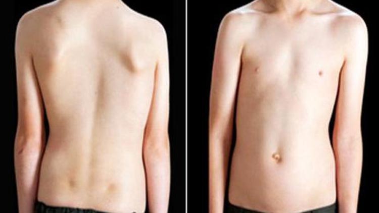Türkiye'de her 100 çocuktan 3'ü skolyoz