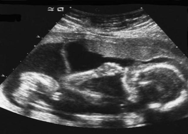 Süreyya Yalçın hamile olduğunu duyurdu!