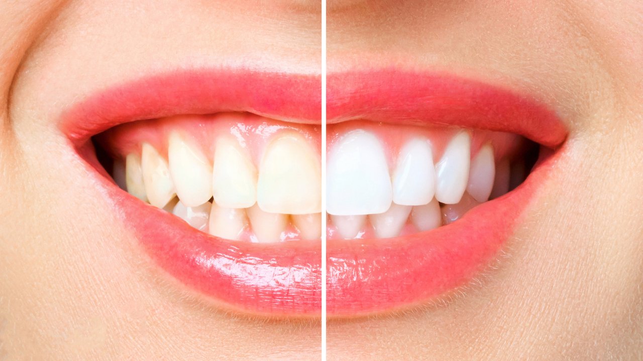 Diş Aralarındaki Siyah Üçgenlerin Gizemi Çözüldü! Uzmanlardan Şaşırtıcı Açıklama ve Kolay Çözüm Önerisi