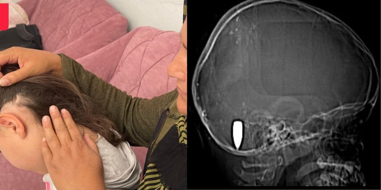 Hastane İhmali: 9 Yaşındaki Kızın Başındaki Kurşun Bir Yıl Sonra Fark Edildi