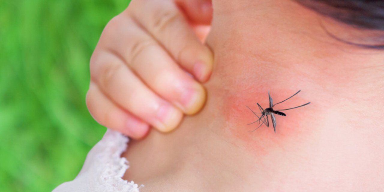 Dikkat! Sivrisinek Isırığına Bu Maddeleri Asla Sürmeyin