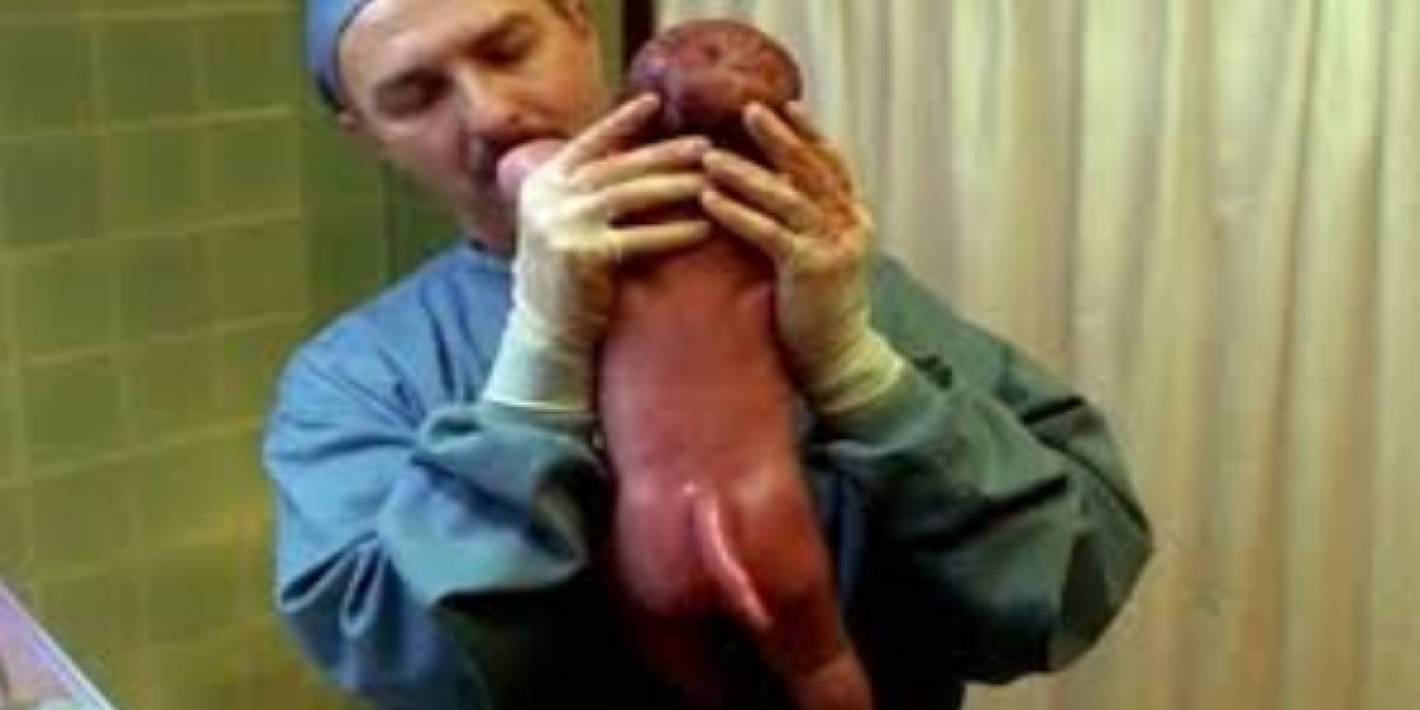 3 Aylık Bebekten “İnsan Kuyruğu” Ameliyatla Çıkarıldı!