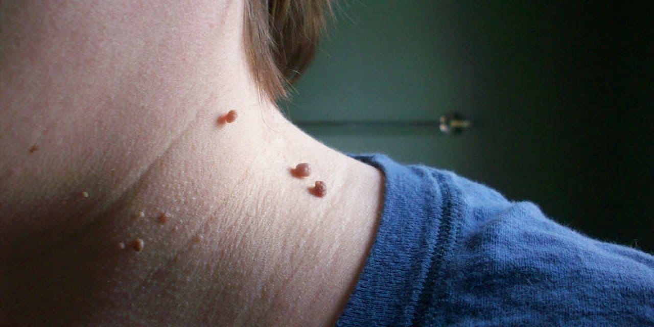 Soğan ve sabun ikilisi:  Papillomları ortadan kaldırmak için etklili bir babaanne tarifini deneyin, etkisini  görün