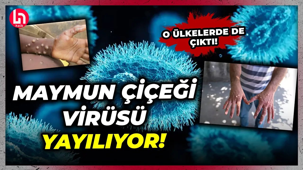 Dünya diken üstünde! Maymun çiçeği virüsü yayılıyor! Yeniden kapanacak mıyız?