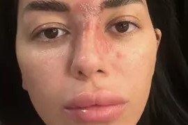 Burnuna dolgu yaptıran kadın bilinç kaybı ve geçici körlük yaşadı