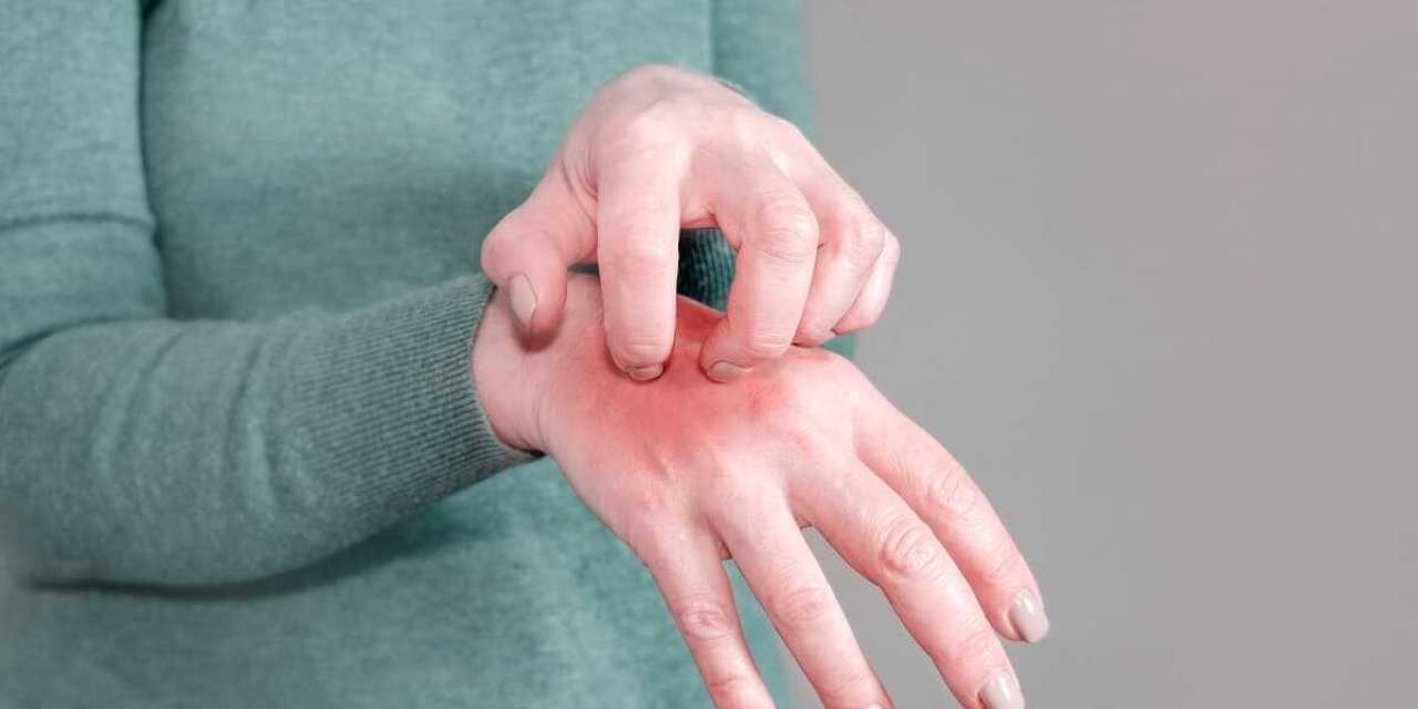 Uyuz vakaları her geçen gün artıyor