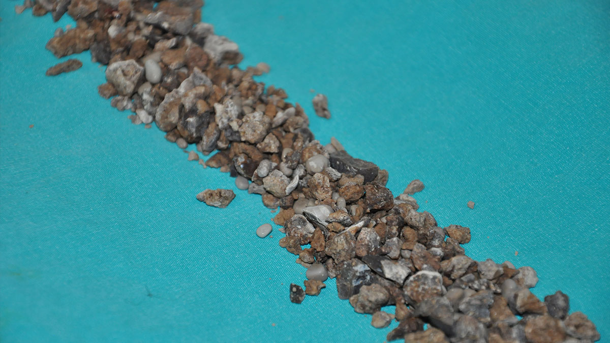 Böbreklerinden 500'den fazla taş çıktı: Vücudumda bir maden ocağı taşıyormuşum