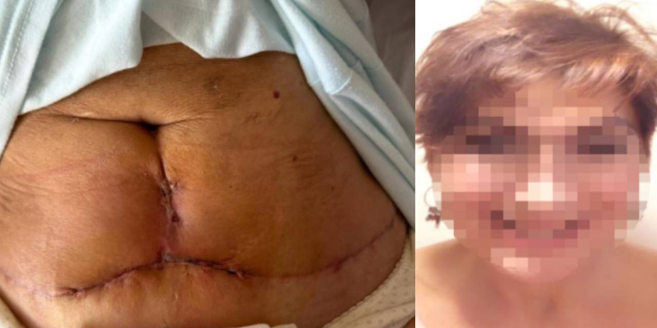 Kol ve karın germe ameliyatı oldu hayatı karardı!