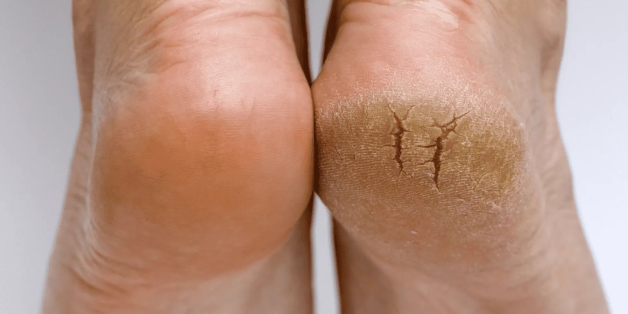 Çatlak topuklara  bu ucuz ve basit yöntemle veda!