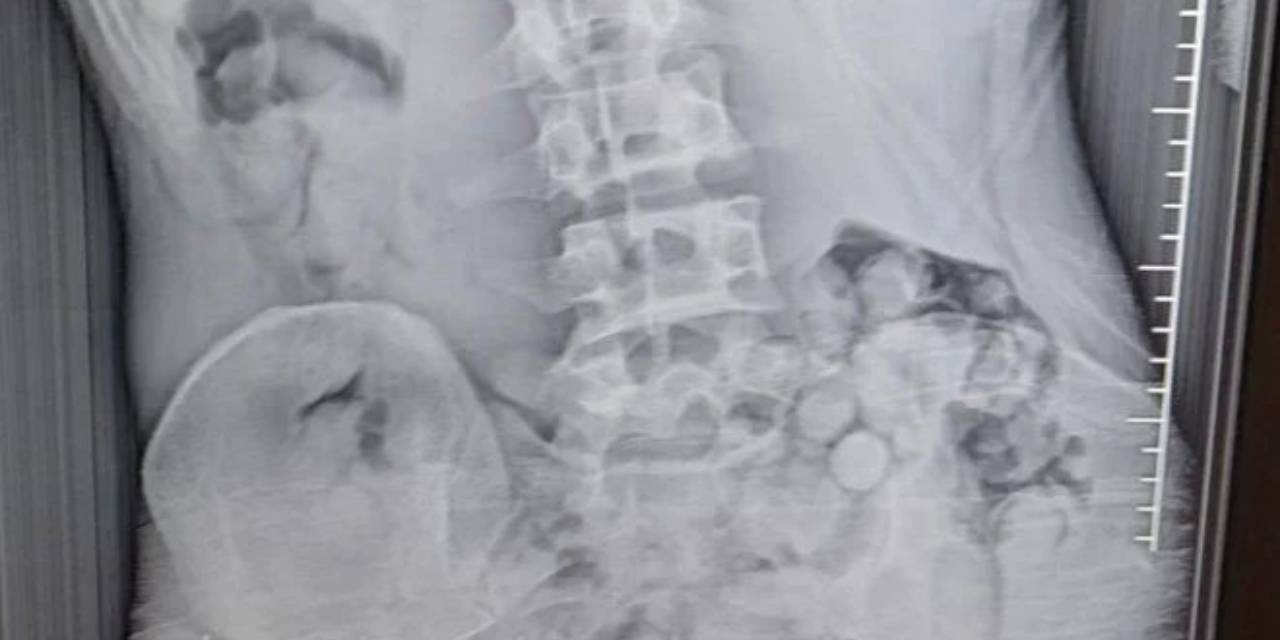 Midesinde 309 gram uyuşturucuyla yakalandı