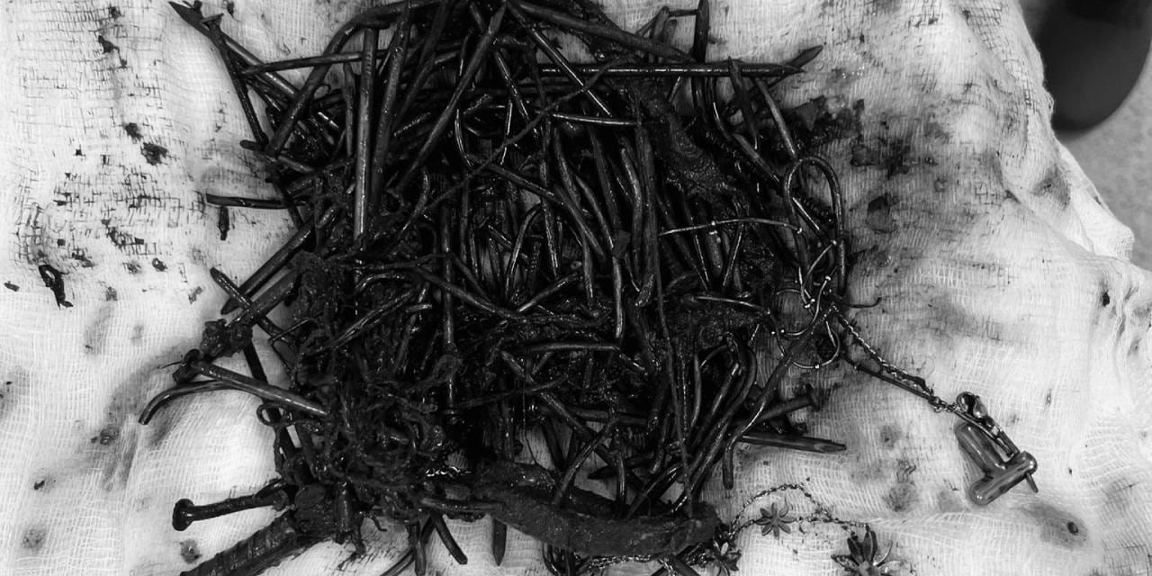 Doktorlar gözlerine inanamadı. Midesinden 1 kilo çivi çıktı