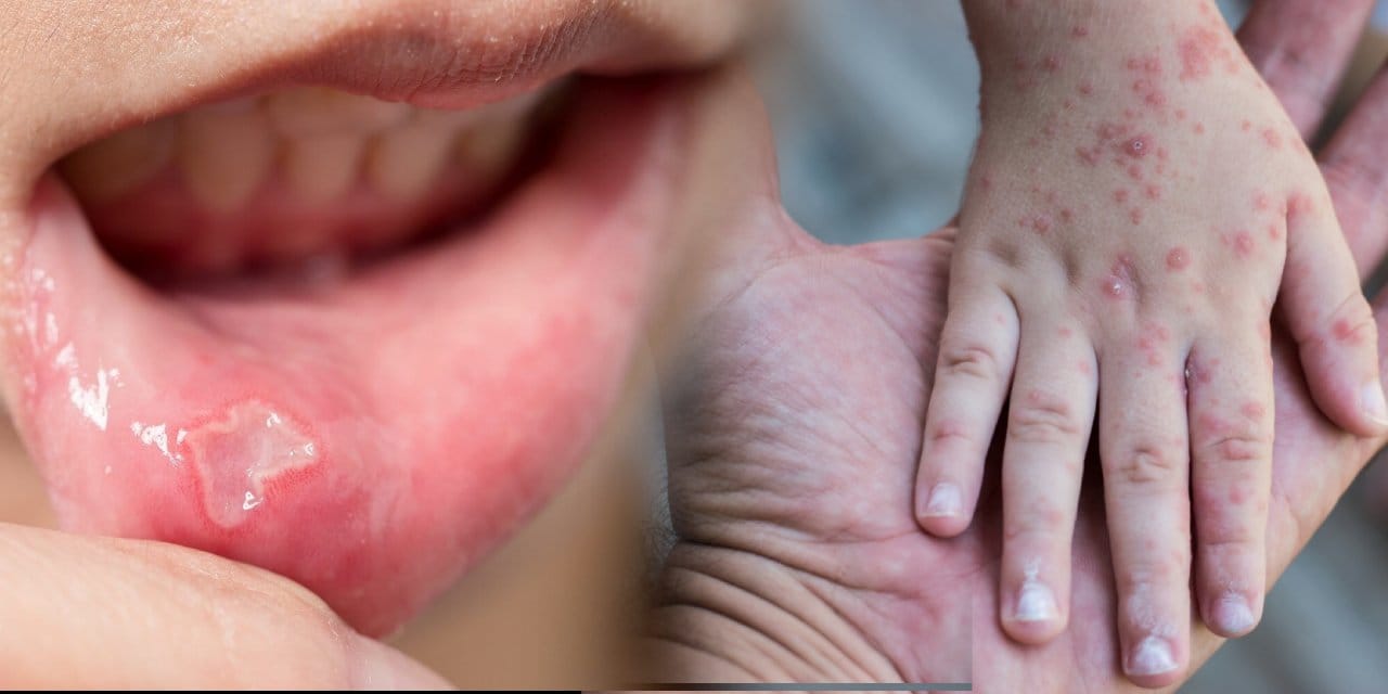 Çocuklardaki bu hastalık el ve ağızda yara yapıyor. Tedavisi ise sade dondurma