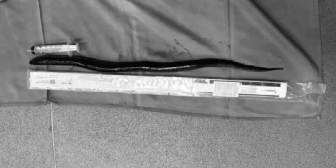 Karnından 30 santimlik yılan balığı çıktı