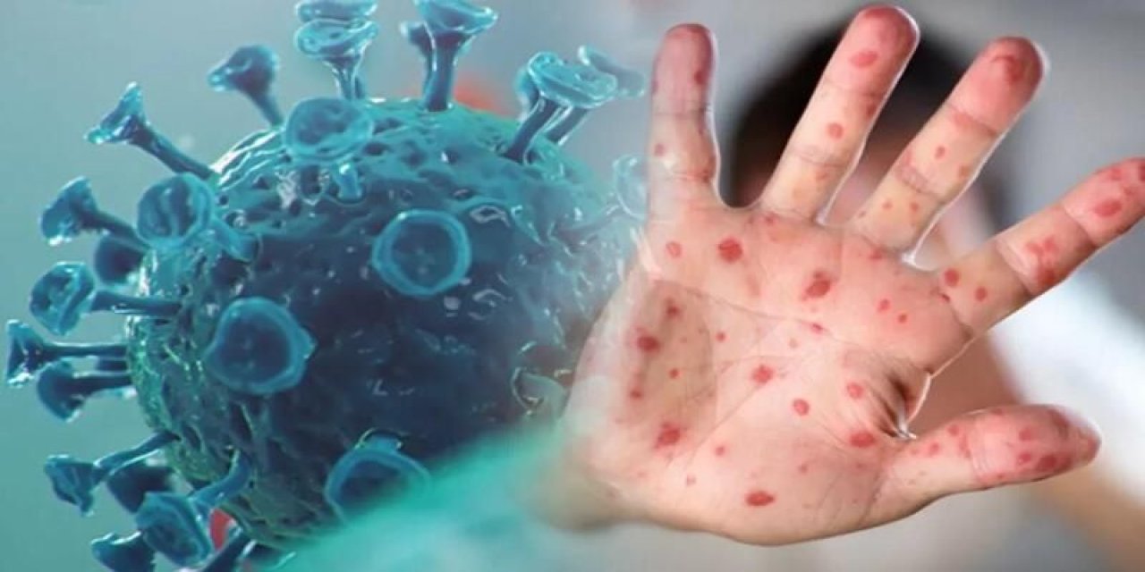 M çiçeği virüsünün yeni varyantı Fransa'da ilk kez tespit edildi