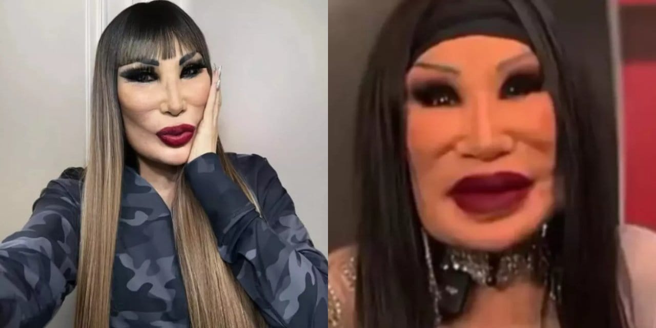 Estetikle yüzüne yemeklik yağ enjekte edildi