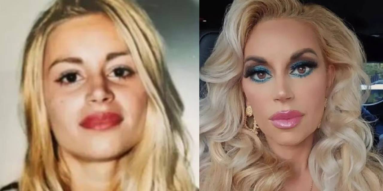 Yüzüne başkalarının yağını enjekte ettirdi: Bu yönteme 400 bin lira harcadı