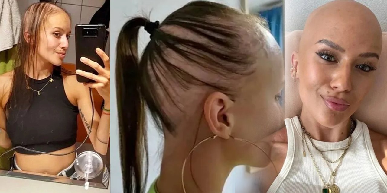 Göğüs büyütme ameliyatı olunca kel kaldı