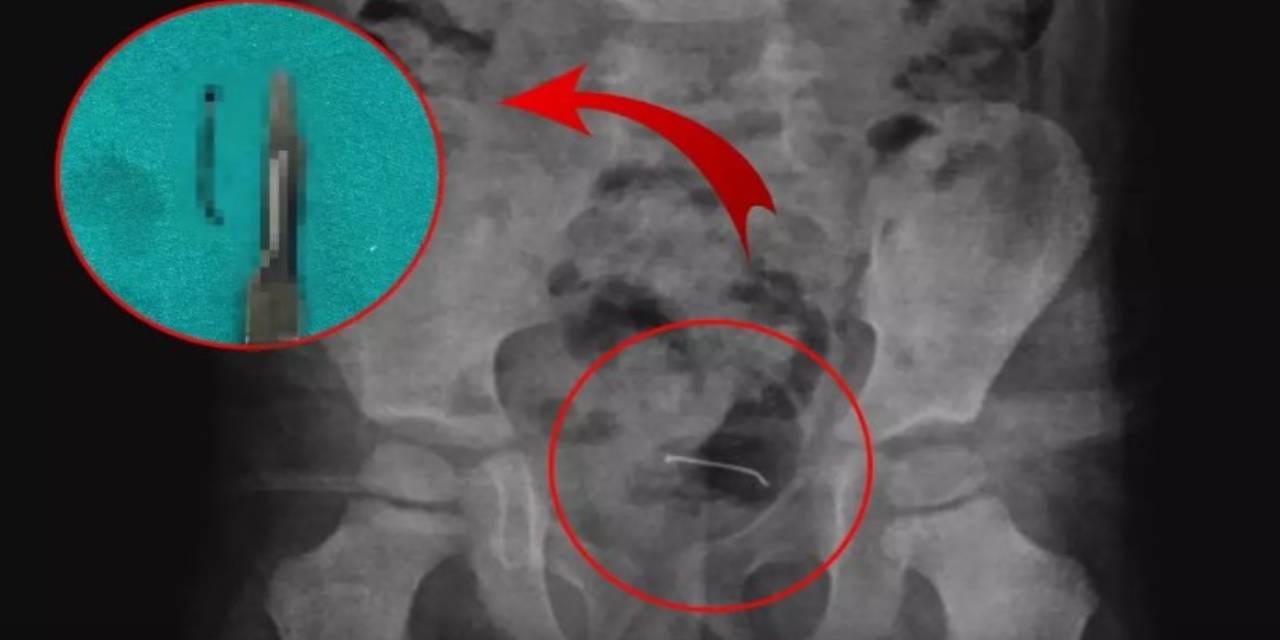 5 yaşındaki çocuğun mesane duvarından çıkan doktorları bile şoke etti