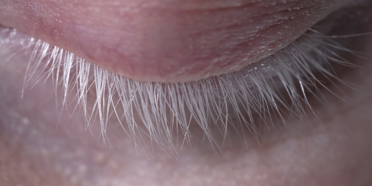 Görünmeyen renklerle kendi ışığını yaratmak: Albino olmak