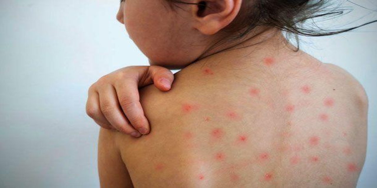 Kızamık salgını yayılırken vaka sayısı 222'ye yükseldi