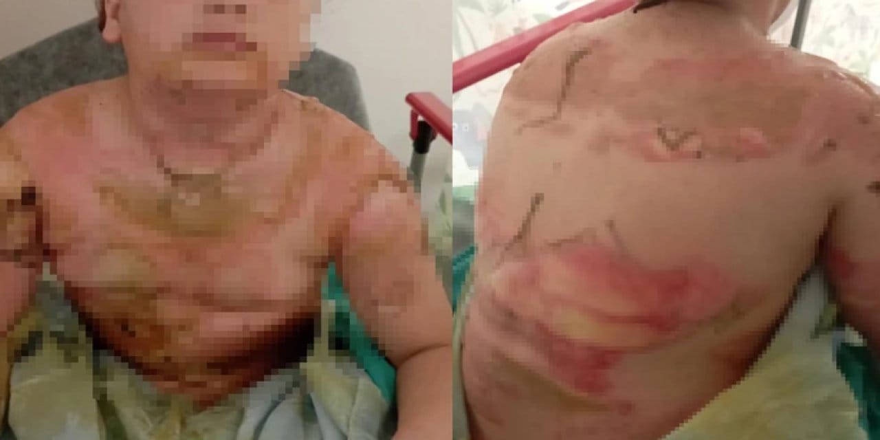 Sınıfta korkunç anlar: 10 yaşındaki çocuk yandı