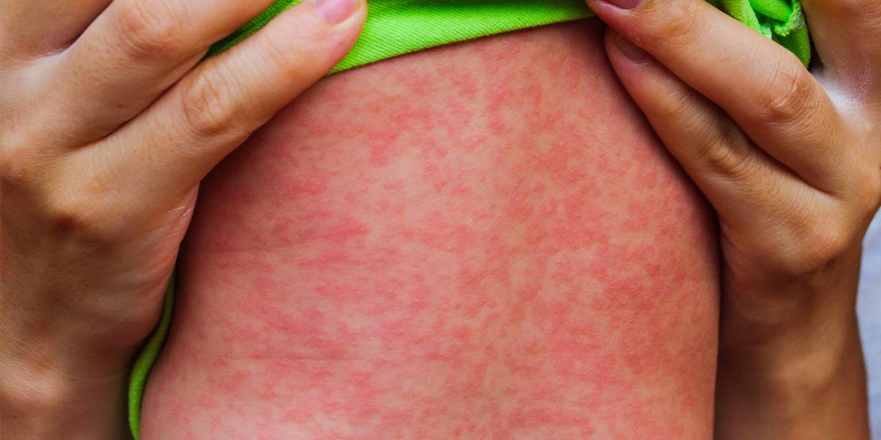 27 yıl sonra hortladı: Tüm vücuda kırmızı kırmızı yayılıyor