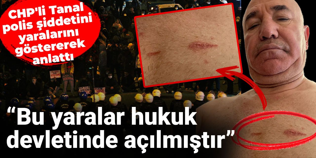 CHP'li Tanal polis şiddetini yaralarını göstererek anlattı: Bu yaralar hukuk devletinde açılmıştır