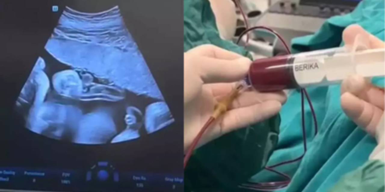 Anne karnındaki 8 aylık bebeğe kan nakli yapıldı
